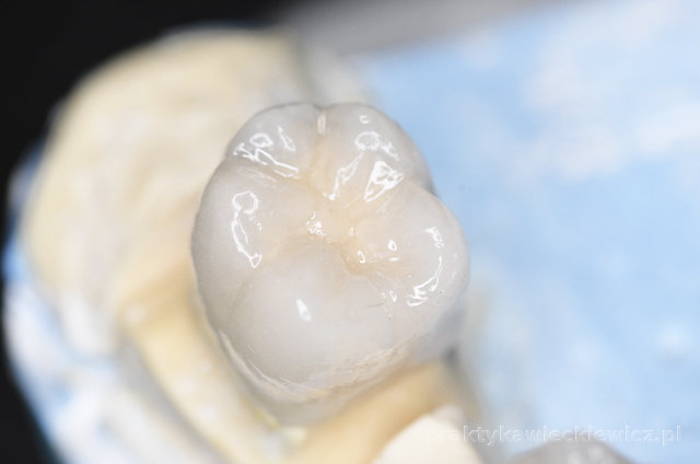 Korona protetyczna metalowo-ceramiczna na zębie naturalnym
